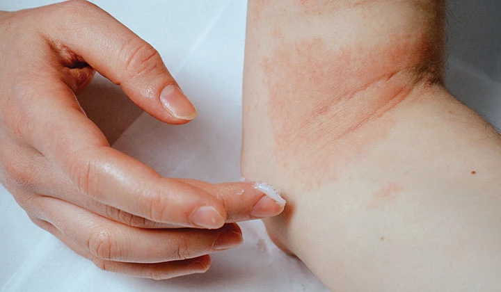 Neurodermitis in der Armbeuge Trockene, gerötete Haut als ein Symptom der Neurodermitis
