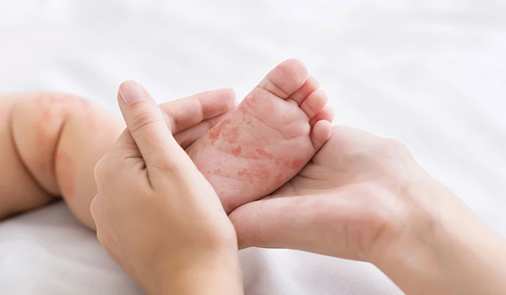 Mutter hält Fuß des Babys Hautausschlag trifft nicht selten auch Babys und Kinder
