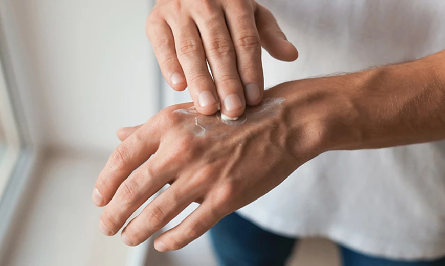 Schuppende Haut bei Dermatitis Dermatitis als Hautentzündung